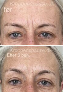 Naturlig ansigtsløft
